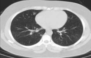 سی تی اسکن مربوط به بیماری کوید - 19